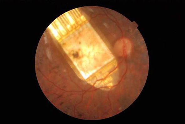 Luisovoj je implantiran pravougaoni cip u zadnjem dijelu retine